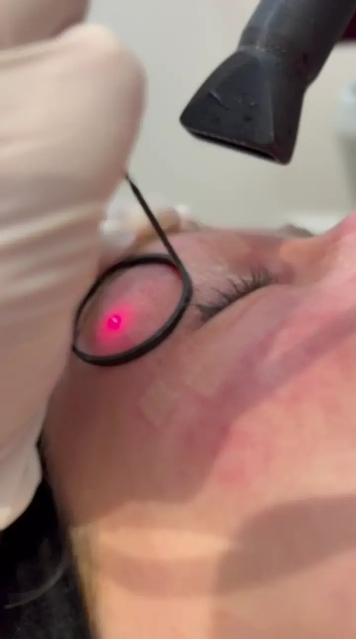 Capa do vídeo: Laser CO₂