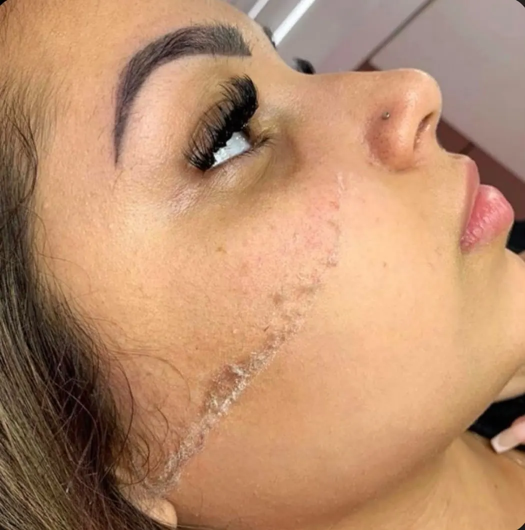 Dermaplaning
